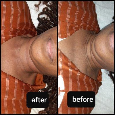 RF skin tightening to lift and tightening loose skin