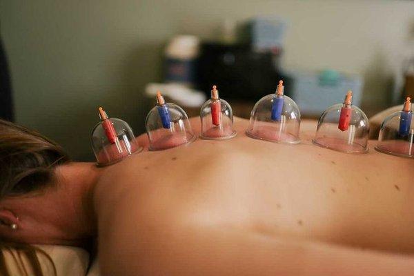 Cupping therapy