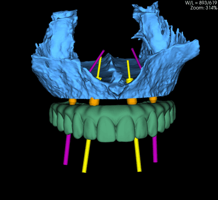 At Nevada Oral and Facial Surgery we virtually plan surgeries ahead of time to see exactly where your implants should be placed.