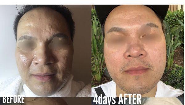 Fractional Radiofrequency (RF) Microneedling