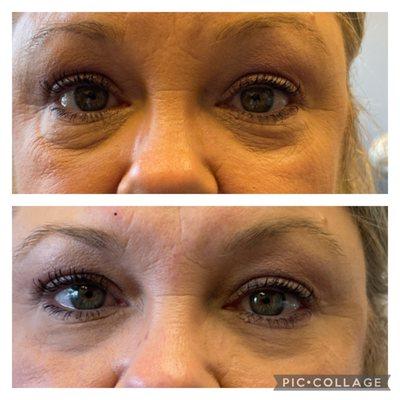 Before and after Noella eye cream!!