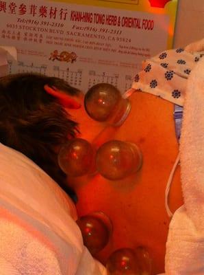 Acupuncture and cupping for 50 dollars.!! Love how Dr made sure my mom was understanding.