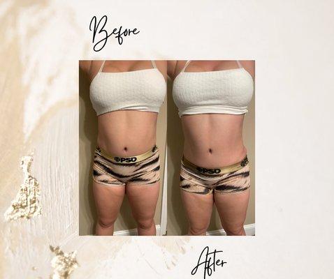 Slim Waist Body Sculpting Treatment