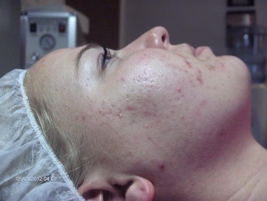 Acne Before