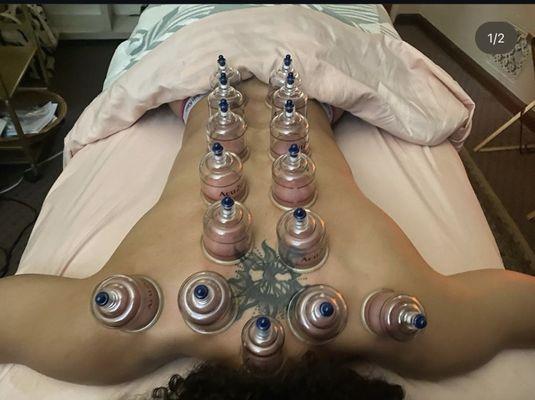 Cupping on the back