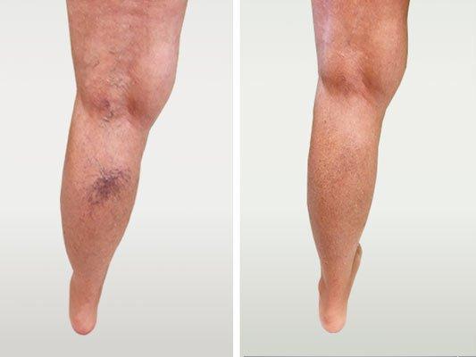 Spider veins before and after sclerotherapy x 3