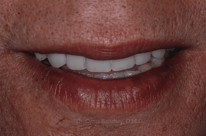 After- Dentures