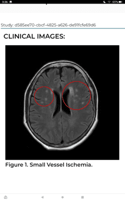 Chronic micro vascular white matter changes.