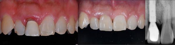 Failing front tooth was replaced by  dental implant.