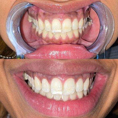 Teeth Whitening in Brooklyn, NY