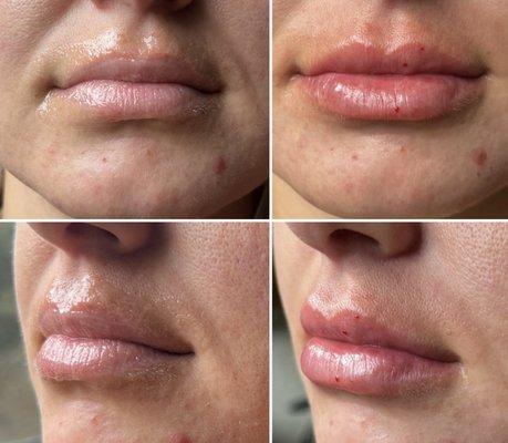 Lip injections with Juvéderm Volbella