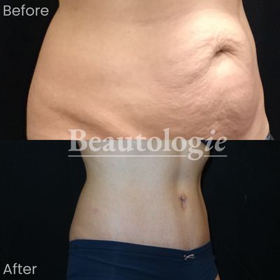 Tummy Tuck Before and After