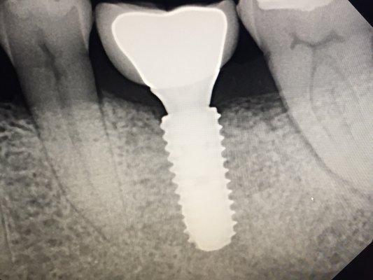 Implant, custom abutment and crown placed by Dr. Daniel Ma using 3D cone beam guided technique in 2017.