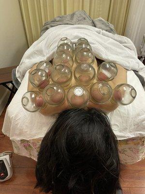 Doctor recommended everyone get cupping few times a year, that helps body immune system, and get energy!