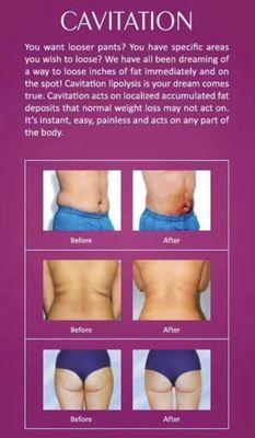 Lipo Cavitation, Body Contouring, Body Sculpting