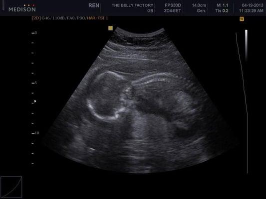 First ultrasound...