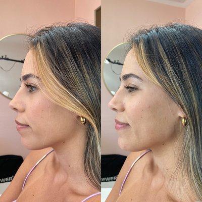 Jawline and chin augmentation