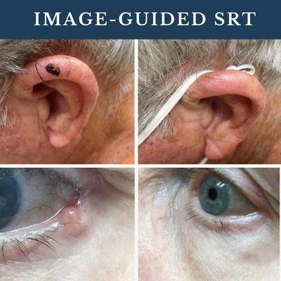 Image Guided SRT in Cleveland offered at Haber Dermatology