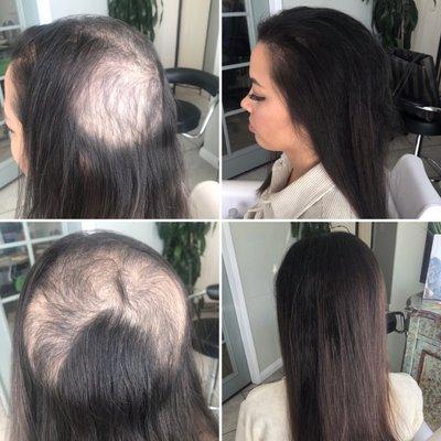 Hair Barrier for Trichotillomania