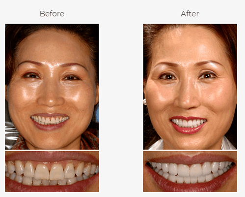 Full mouth reconstruction: Crowns and veneers were used to build up this patient's bite and enhance her smile.