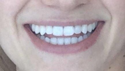 After. A beautiful white smile that I am happy to show off.