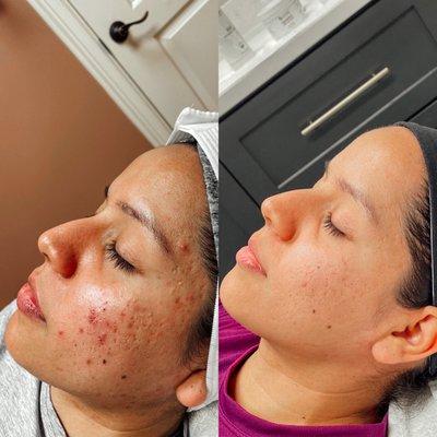 Before and after
Acne facials and microchaneling