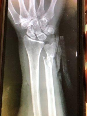 Repaired fractured ulna with partial bone loss .