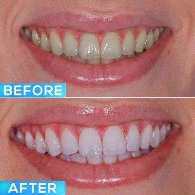 GloScience Professional Whitening, Amazing results!