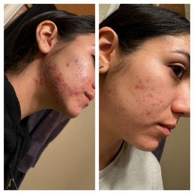 Acne facial. A few months apart.