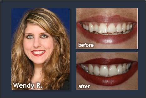 Before and After, Vacaville's Cosmetic Dentist Bruce Bosler DDS