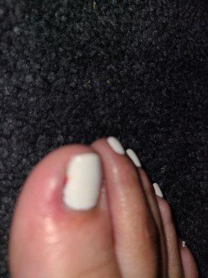 Swollen big toe and bruised