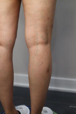 If you have spider veins or varicose veins, it is importantly do not neglect him.  Call us for an ultrasound vein scan,