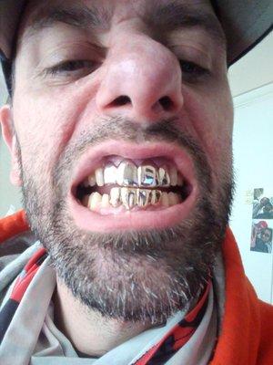 Gold Teeth