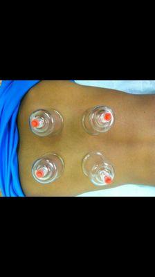 Cupping, has many health benefits.