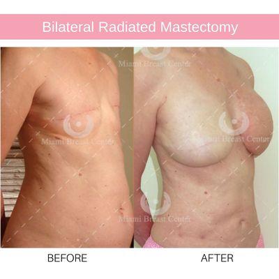 50 year-old woman with a bilateral mastectomy and radiation therapy. She regenerated her natural breasts without any incisions or implants.