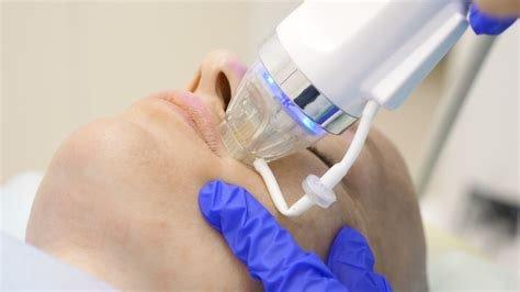 RF Microneedling to address large pores, fine lines & wrinkles, sagging skin, scar modification & stretch marks.