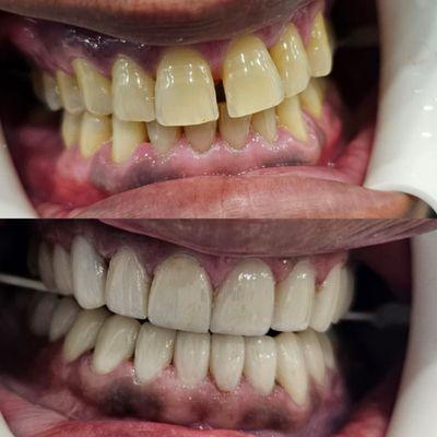 Patient's smile fixed with a beautiful natural looking porcelain veneers