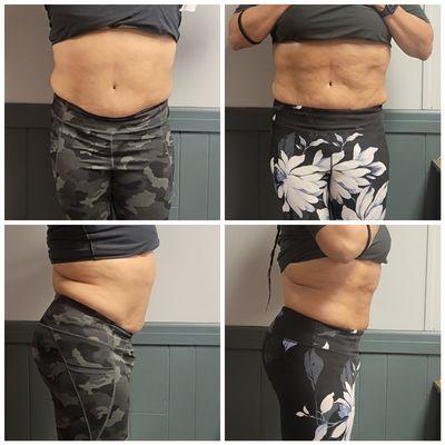 4D Lipo Fat Reduction 4 sessions