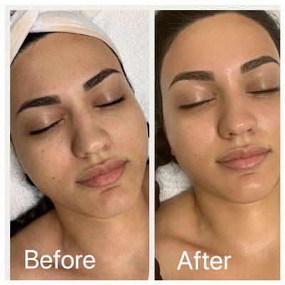 Just one facial makes a difference!!