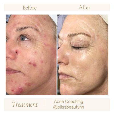 We are Face Reality certified acne experts, your personal acne coaches here to encourage, advise, and guide you to clear skin.