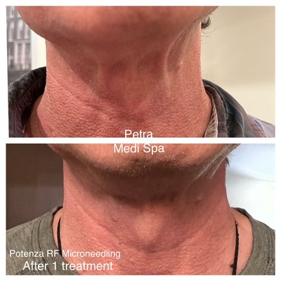 Potenza RF Microneedling, One month after the first treatment.