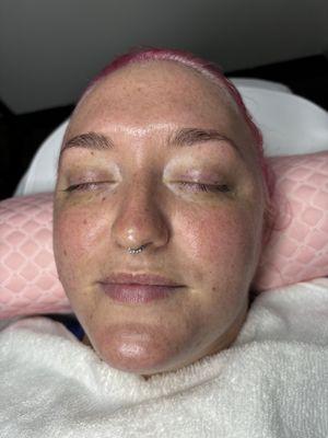 Microdermabrasion! Just look at that beautiful skin glowing!