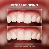 Dental bonding, dentist marbach road