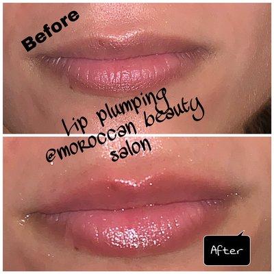 Lip treatment hydration