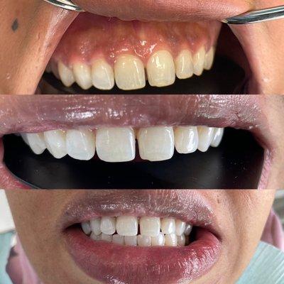 Teeth Whitening ( bleaching)