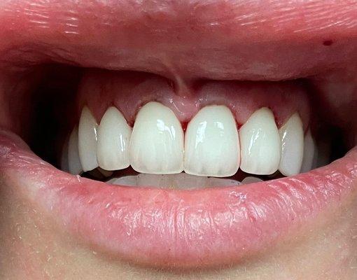 4 Anteriors Esthetic Crowns