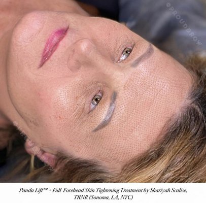 Plasma lift skin tightening (Panda Lift + Full Forehead)