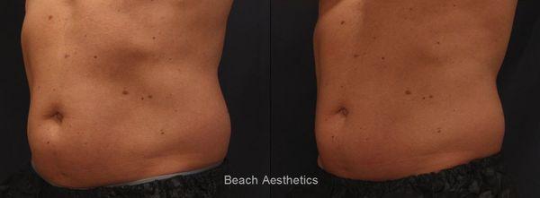 SculpSure - Body Contouring - non-invasive fat reduction