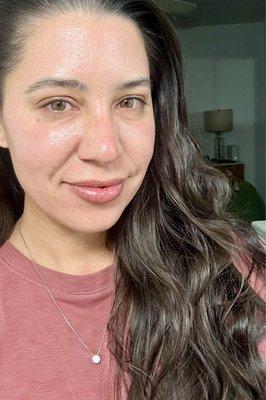 Exactly 1 week post BBL + Halo. So much sun damage is gone and my skin has never had that glow before. So happy!