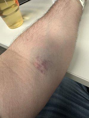 Bruising on the second day from multiple blood draw attempts and failures due to inexperience.